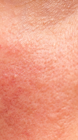 rosacea