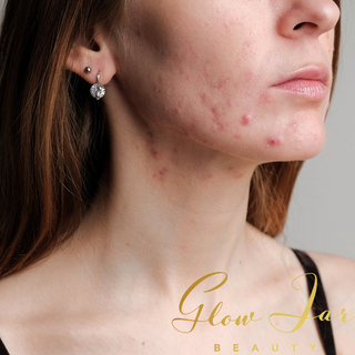 Skin Purging 101: What It Is and Why it Happens