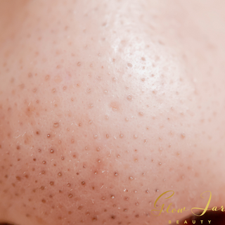 Blackheads Vs. Sebaceous Filaments: Key Differences and How To Deal With Both