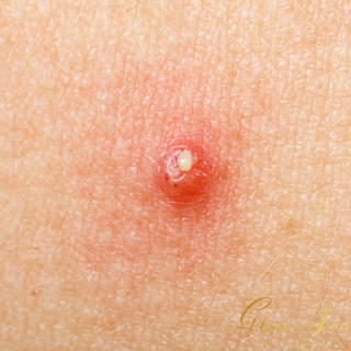 Cystic Acne 101: The Basics On Dealing With Painful Breakouts