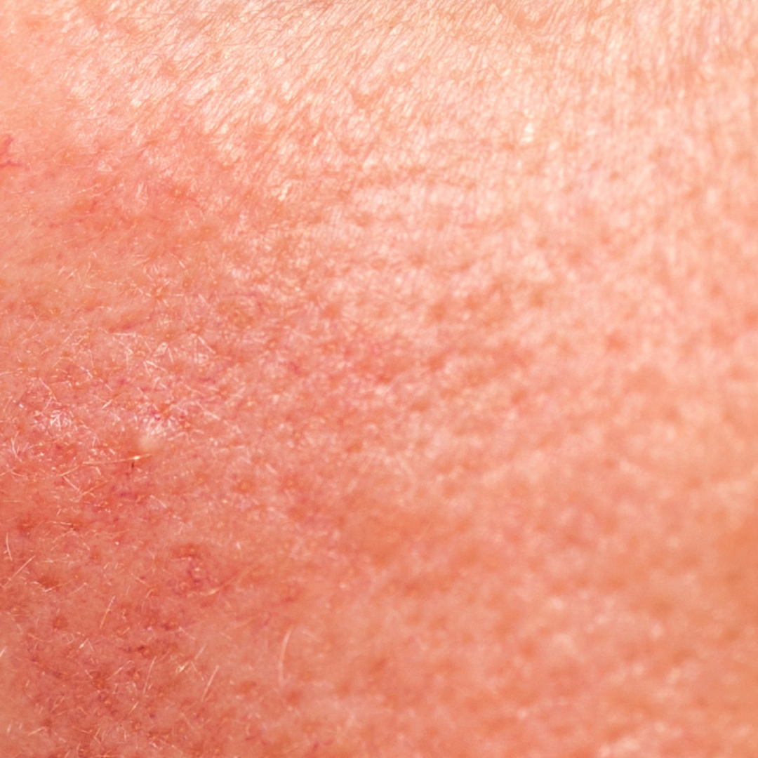 rosacea