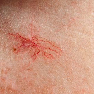 Understanding Broken Capillaries + Our Tips for Prevention and Treatment